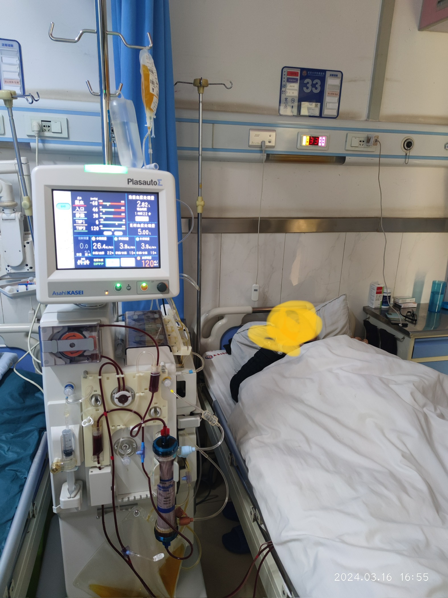 世界杯官方网站中文版肾内科成功开展双重血浆置换救治ANCA相关性肾炎患者
